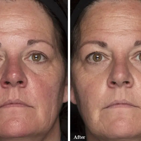 How Addressing Excess Iron in Skin Helps Restore Balance and Slow Visible Aging