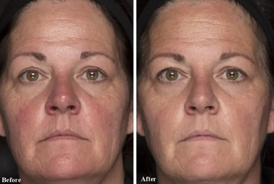 How Addressing Excess Iron in Skin Helps Restore Balance and Slow Visible Aging